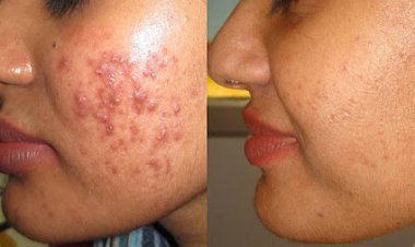 முகப்பரு தழும்புகளை நீக்க உதவும் வெந்தயம் !