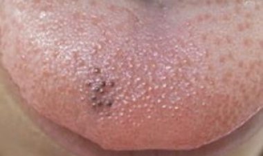 நாக்கில் உள்ள கரும்புள்ளிகளை உடனே போக்க